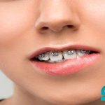 هر آنچه که باید در مورد ارتودنسی دندان بدانید !